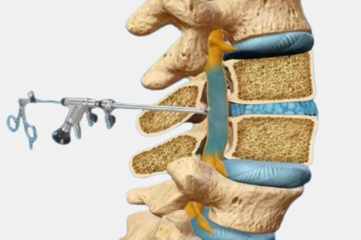 Foraminoplasty & Annuloplasty